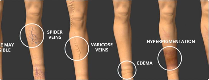 Varicose Veins And Treatment